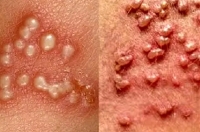 دشمن زگیل تناسلی چیست؟ آشنایی با راه های پیشگیری از زگیل تناسلی