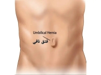نکات مهم مراقبت بعد از جراحی فتق ناف