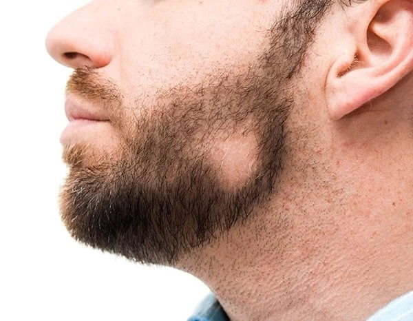 ریزش سکه ای ریش چیست و چگونه آن را درمان کنیم؟