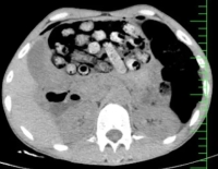 خروج 90 بسته مواد مخدر از معده و روده یک بیمار در کرج