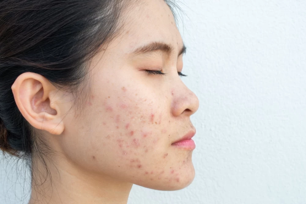 تاثیر ضد آفتاب بر جوش صورت