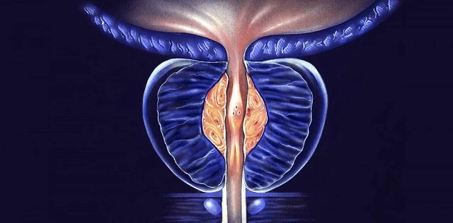 دلیل مبتلا شدن به سرطان پروستات