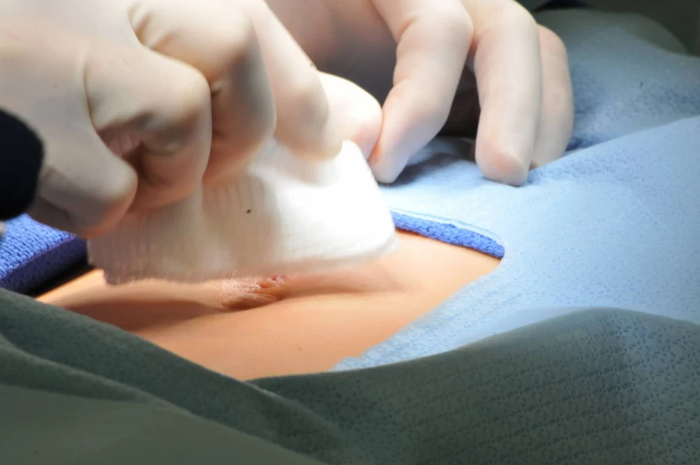 جراحی فتق اینگویینال