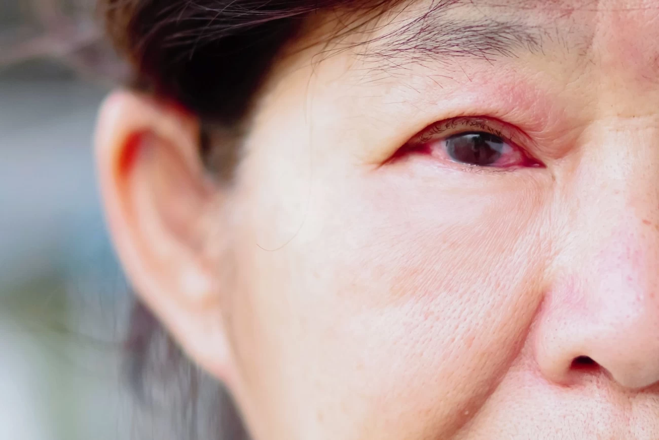 لکه های قرمز روی چشم