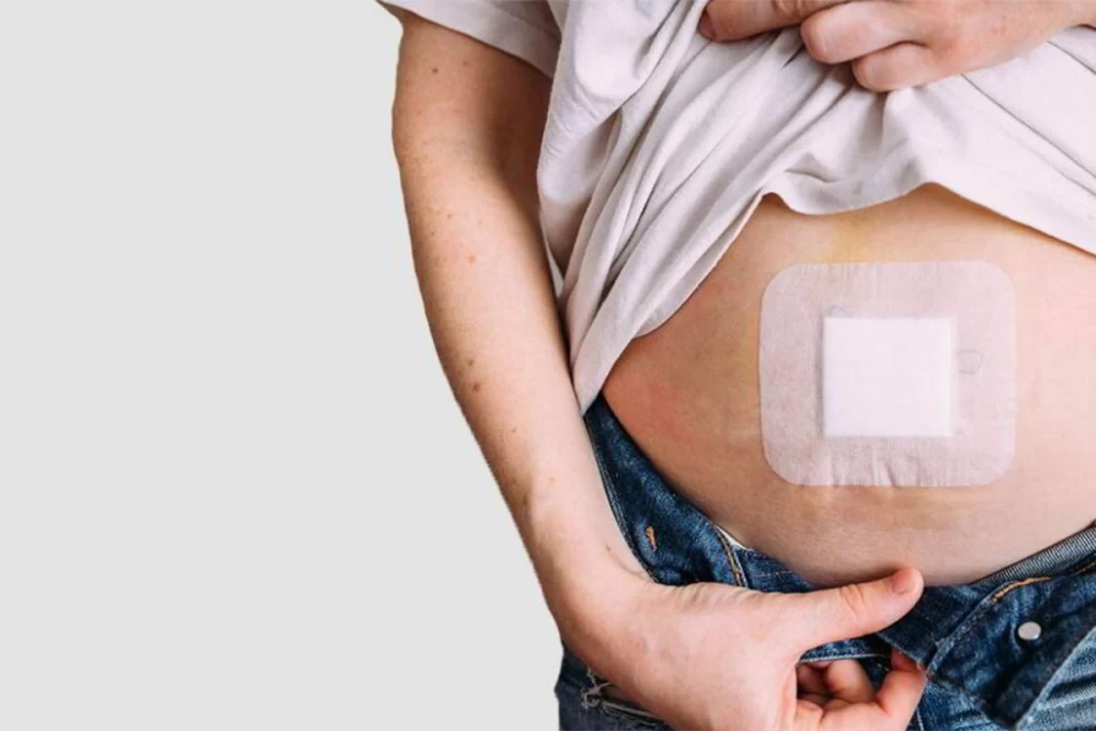 عمل جراحی فتق