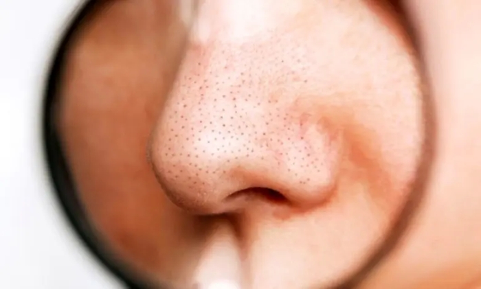 چگونه منافذ باز بینی را با روش‌های خانگی از بین ببریم؟