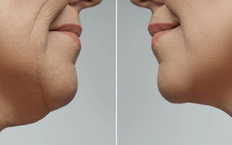 روش های از بین بردن و درمان غبغب